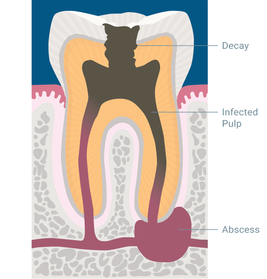 Graphic of an infected tooth with decay, infected pulp and an abscess